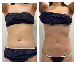 ミニモ限定【お腹痩せ】ダイエットマシンで頑固な下腹部/燃焼!まで燃1回でも効果有!