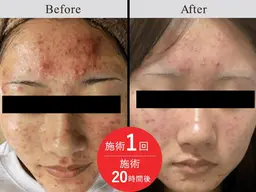 【ミニモ学割】医師監修の幹細胞培養液×マスクでトラブルニキビに効果的！60分