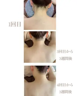 ✨うなじ・肩・背中上まで脱毛✨1回都度払い💎見せれる綺麗な後姿に💎