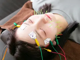 ミニモセール✨本格美容鍼＋小顔矯正🪡