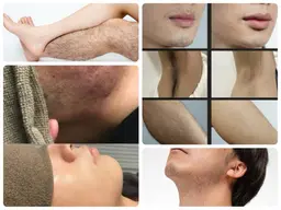 【脱毛・男性限定】★全身＋全顔、VIOなし★　お得な低価格で満足度ＮO.１