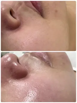 Wax脱毛　顔全体　幹細胞モデリングパック