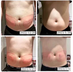 冷却×高周波×次世代EMS 5回コース×酵素付き135分通常348,000円→9,8000円