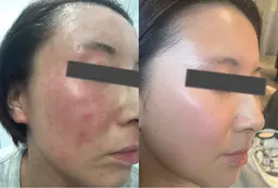 肌質改善カウンセリング🩺（アトピー、ニキビなど）