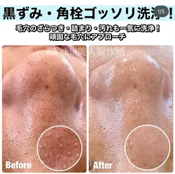 【黒ずみ角栓丸洗い洗浄‼️】ハイドラフェイシャル高濃度水素水のトルネード水流で毛穴を徹底吸引&洗浄＋ハーブピーリング🌿