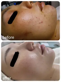 20代に人気✨《ニキビなかったことに！》本気のニキビケアコース2回体験　[大阪城北詰駅/京橋駅]
