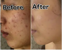 ニキビホームケアご購入相談