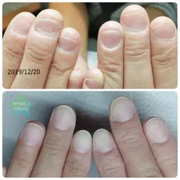 噛み癖や毟り癖のある方に☆深爪ケア