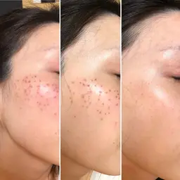 しみ取りなら冬の間に⛄️ダウンタイム1週間！保護テープなし❣️傷みなし❣️