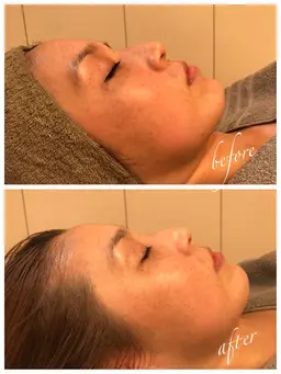 限定SALE💖¥17600⇨¥10000【小顔エステ×美肌ピーリング🌿】整顔＆整肌どちらも叶えるスペシャルコース❣️