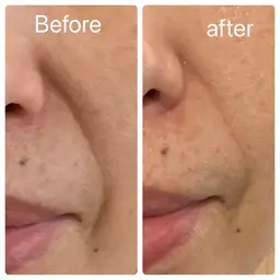 🌈変化感動率100%✨たるみ毛穴撃退‼︎速攻引き上げ❣️メンズも歓迎👨