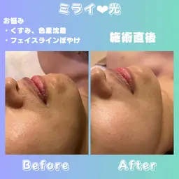 🩵もっちりちゅるん肌🩵時短で頬、口角キュッと小顔フェイスラインくっきり🫧ミライの光と特殊ジェル🍊で効果持続✨️