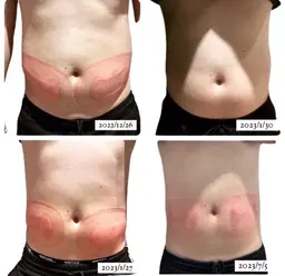 【冷凍痩身20カップ➕EMS10回】リバウンド知らず/部分やせ/寝ながらダイエット