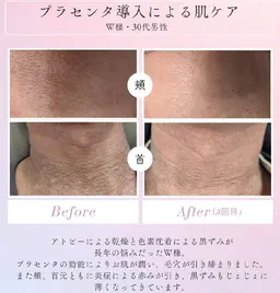 【メンズもOK】プラセンタフェイシャル（高速エアジェット）30分