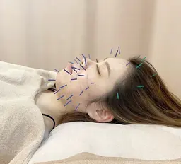 🉐【初回限定】ベーシック美容鍼