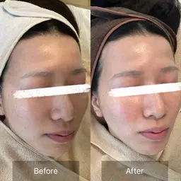 🌿剥けないハーブピーリング✨【剥離なし】【毛穴洗浄】【美容液】ニキビ/ニキビ跡/黒ずみ/水光肌/剥離ありは+1000円