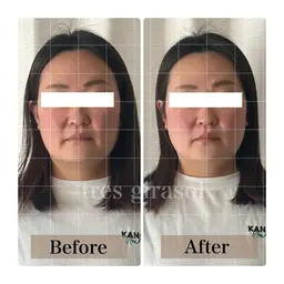 【3名様限定】美骨小顔矯正モニター募集♡