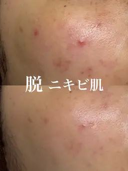 【ニキビ/ザラつきにはこれ】ハーブピーリング