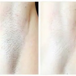 【最新脱毛Man＆Lady👸🏻🤵‍♂️】ワキ脱毛　自己処理卒業の第一歩に✨数分で完了✨　¥7,700⇒\1,100