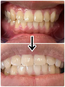 【4w以内のリピーター】歯のセルフホワイトニング🦷サポートあり！15分2回照射で満足な白さに！