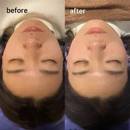 ・✨美容鍼灸✨スペシャルプラン/約80本の鍼を使用した顔鍼と体の中の状態からケアしていく美容鍼🪡