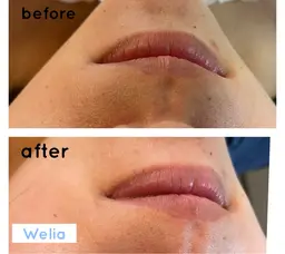 【ご新規様限定】お顔の産毛！一部位お試し！糸脱毛¥1500