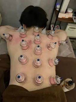 💖肩・背中スッキリ✨上半身カッピング🔥