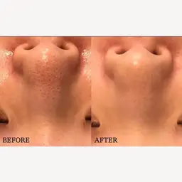 【2段階毛穴洗浄/肌診断付】アクアポアで毛穴&角質黒ずみ洗浄！