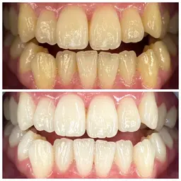 【初回体験】スーパーホワイトコース「歯のセルフホワイトニング］