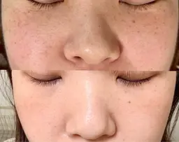 新メニュー【ホワイトラボ🫧】シミ・そばかす・肝斑でお悩みの方へ🌷※15分取り放題　ホワイトニング15分無料照射🎁