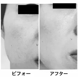 シミくすみ撃退！ 透輝（とうき）フェイシャル（７０分）