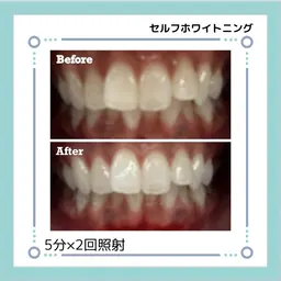 セルフホワイトニング【５分×3回照射】