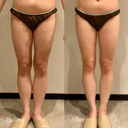 スタッフ🈯️【下半身集中70分🔥美脚コース✨】頑固な凸凹脂肪へアプローチ🔥細い脚を目指したい方、むくみ•冷え改善