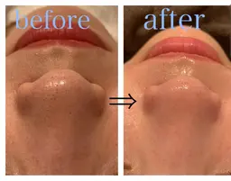 【毛穴エクストラクション】内容⇒ディープクレンジング⇒毛穴洗浄⇒毛穴エクストラクション⇒極上パック⇒高保湿仕上げ