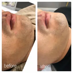 メンズ脱毛❇️ヒゲ集中コース