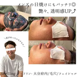 【フェイシャル】季節ケア　メンズ🆗毛穴詰まり＋日焼けをリセット💫毛穴エクストラクションと炭酸ガスパックで解決🔥
