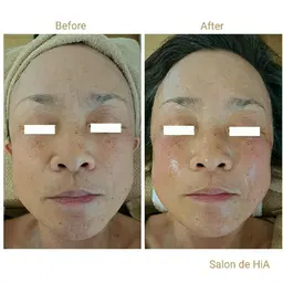 ✨新登場✨50分🕑️💎話題のニードルピーリング💎チクチク感がクセになる方続出💕💕