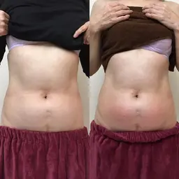 本気で痩せたい人限定‼️各1部位 キャビ＋RFラジオ派＋RF吸引orローラー＋ハンドマッサージ＋赤外線マットコース使って