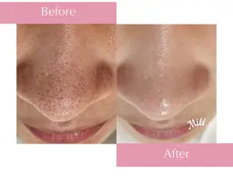 \１周年記念・10名限定/✨年末キャンペーン❄️通常価格¥16,500→¥9,800でご案内！【毛穴＋肌質改善コース】