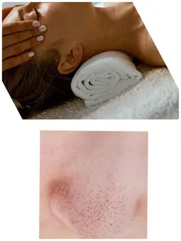 角栓クレンジング