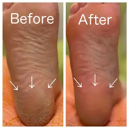 【最新技術】甘皮ケア+ゴワゴワ・カサつきかかと最強フットケアコース¥9350