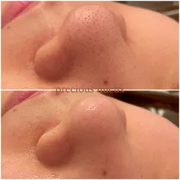 【スペシャル毛穴洗浄🧼】数々の毛穴洗浄を試して1番☝️良かったメーカーさんのものを使用🤩✨毛穴の大掃除メニュー‼️