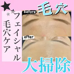 【毛穴洗浄・毛穴すっきり】高濃度炭酸パックと音波の美容機器で毛穴にとことんアプローチ！フェイシャルエステ毛穴ケアコース