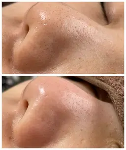 お鼻毛穴エクストラクション