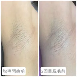 脇脱毛1回