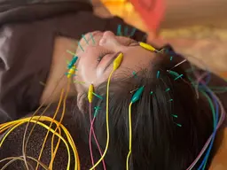 【スピードリフト美容鍼】 ♥️鍼30本【お顔+首肩】むくみ/小顔/ほうれい線/たるみ/リフトアップ💆🏻‍♀️45分