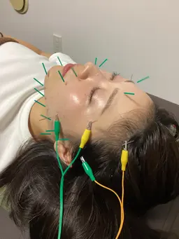 ✨1周年キャンペーン12月限定✨【美容鍼・腸もみ・整体・吸玉・オイルリンパ100分】組み合わせなんでも◎