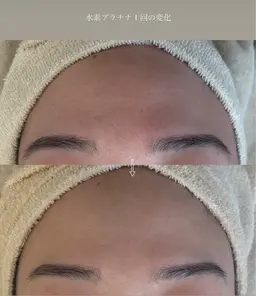 【モデルメニュー】水素プラチナフェイシャル