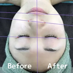 リフトアップ✨光フェイシャル