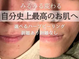 【3回モニター】ハーブピーリング(剥離あり)🌱